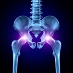 hip replacement verdicts