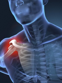 fractured shoulder verdicts
