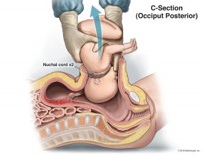 2018csection-1-300x225